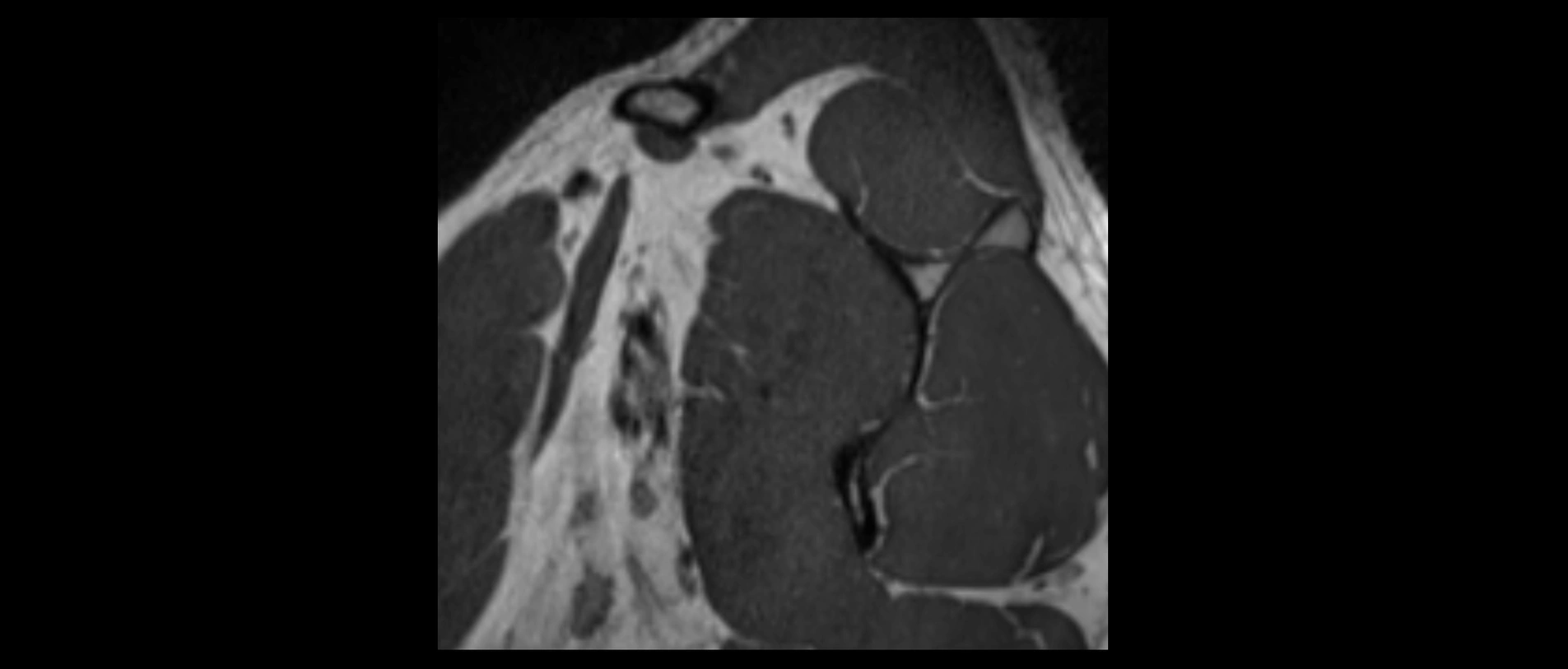 shoulder ligaments sagittal  cross sectional anatomy 3T MRI AI enhanced radiology image -img-00001-00005.webp